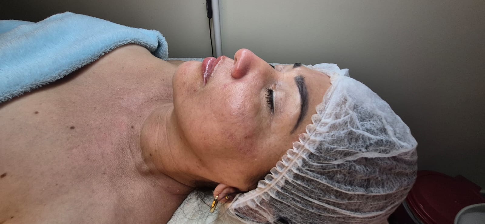Tratamiento facial LP Estética Valledupar