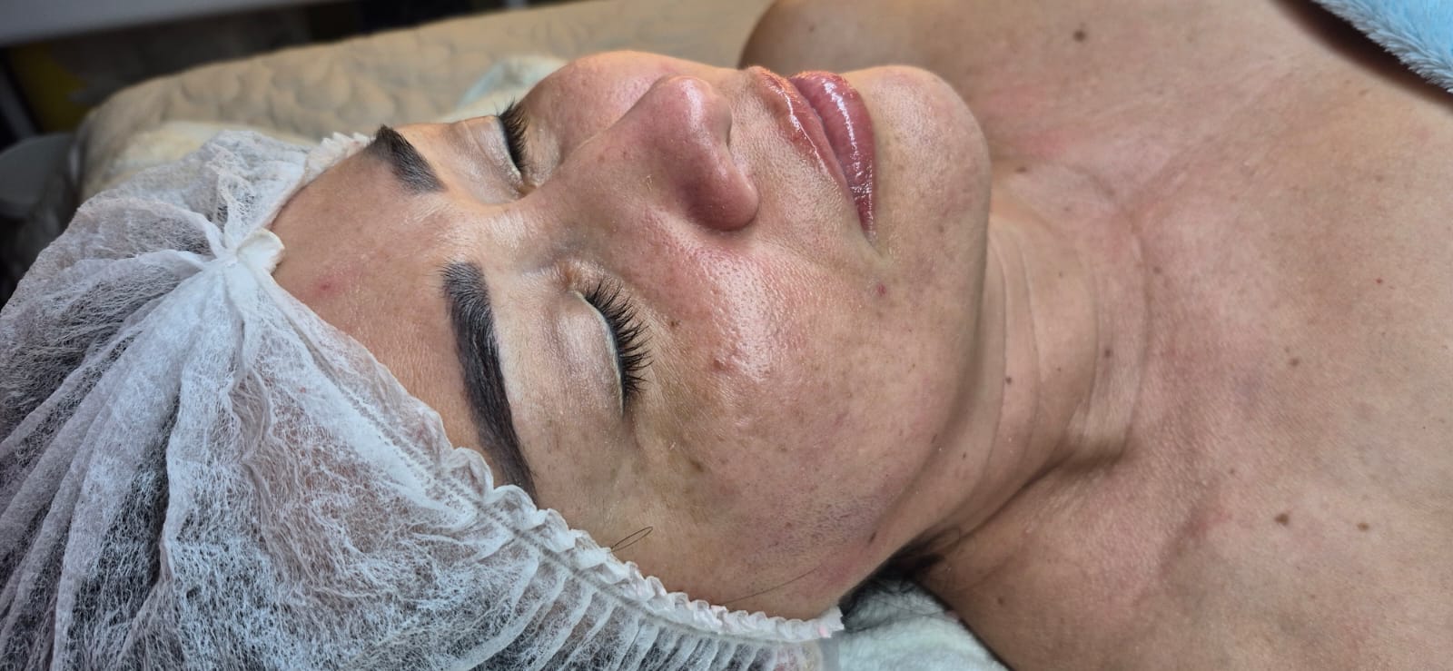 Rejuvenecimiento facial Valledupar