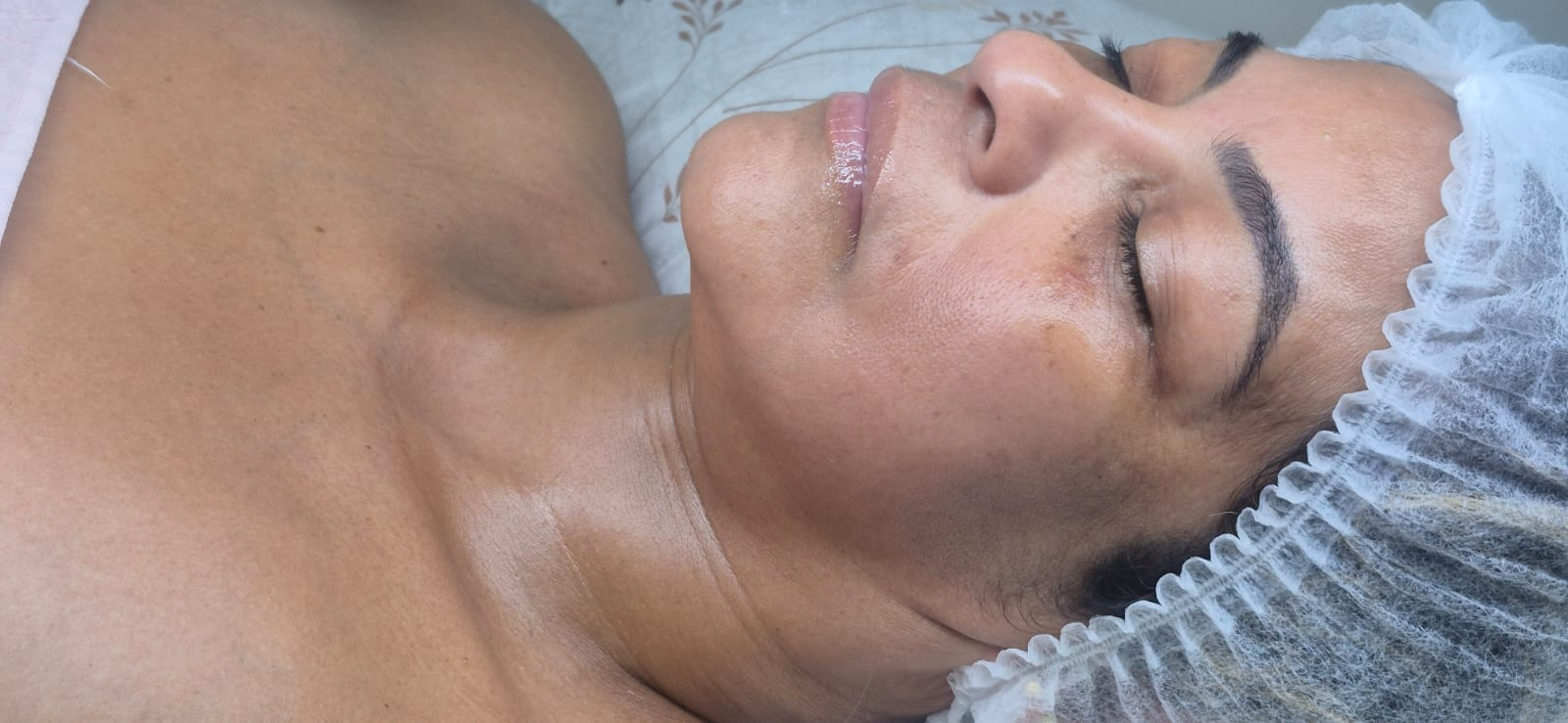 Radiofrecuencia facial Valledupar